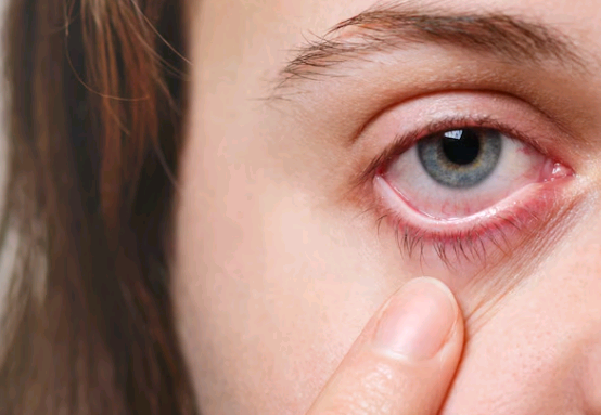 Conjuntivite: a mais frequente doença ocular externa durante o Verão